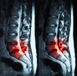 herniated disc injury x-ray